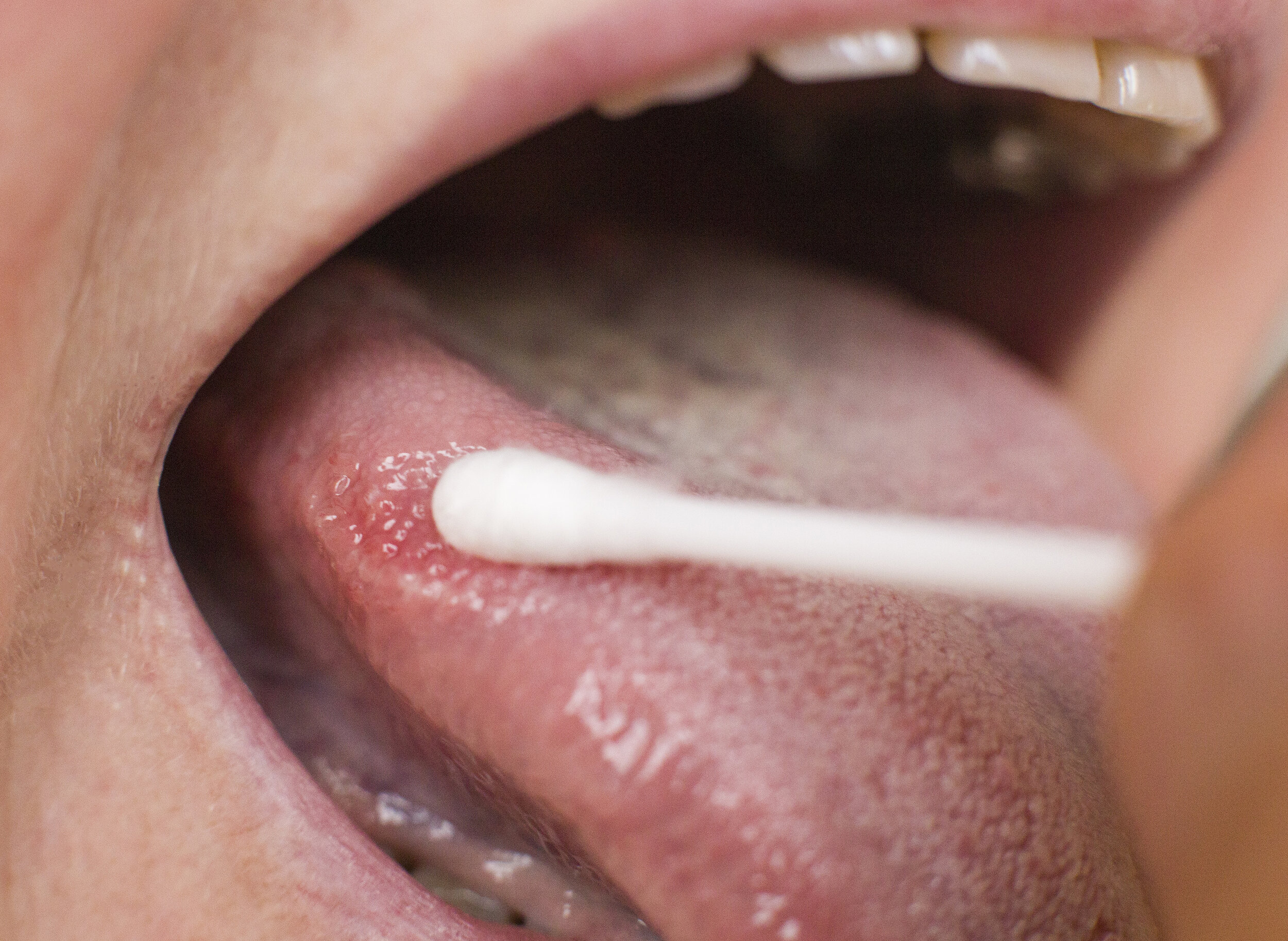Terapias caseros para las grietas en la lengua